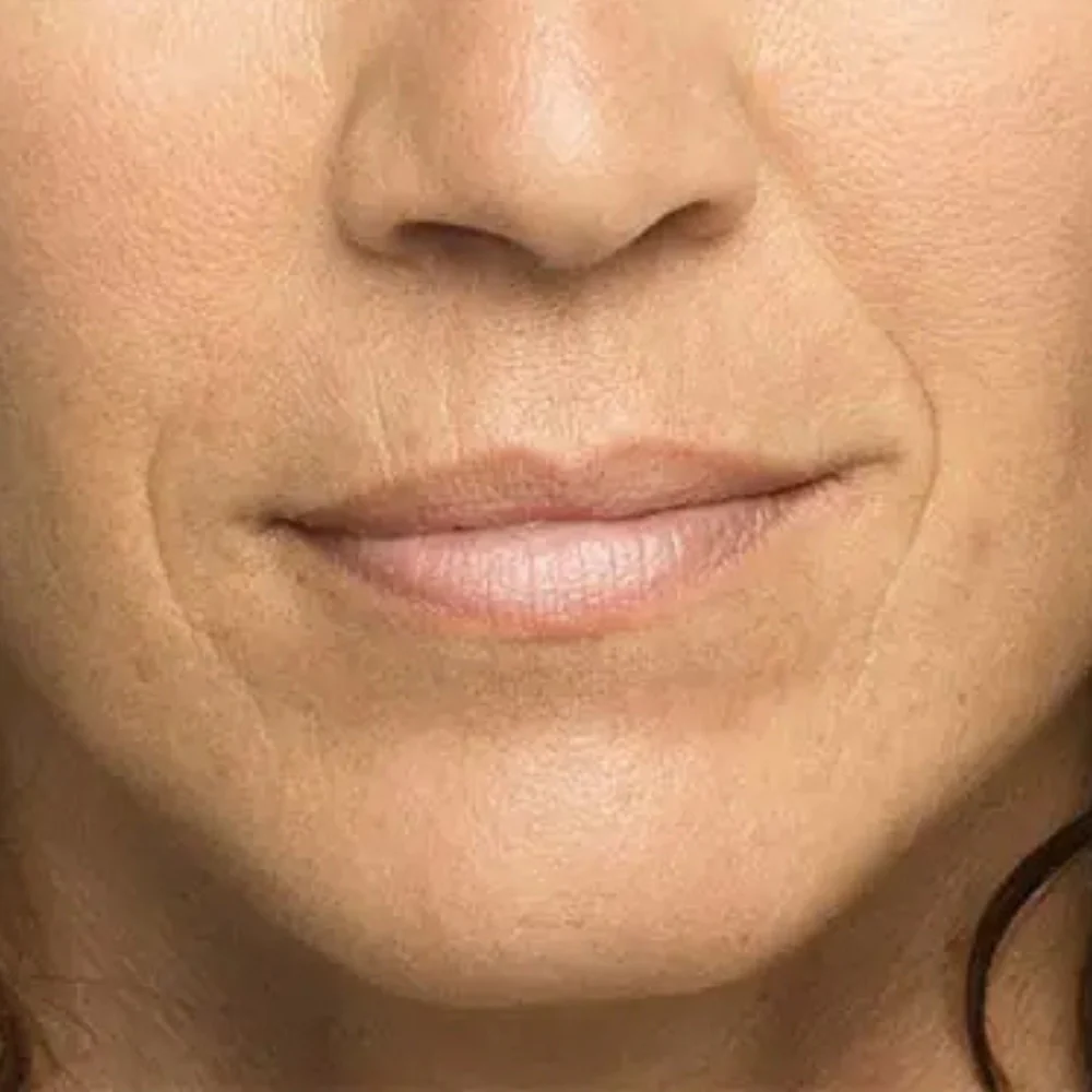 Smile Lines