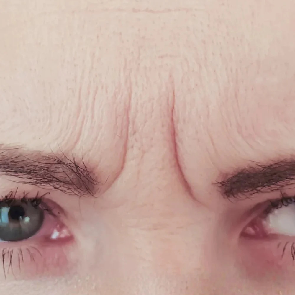 Frown Lines