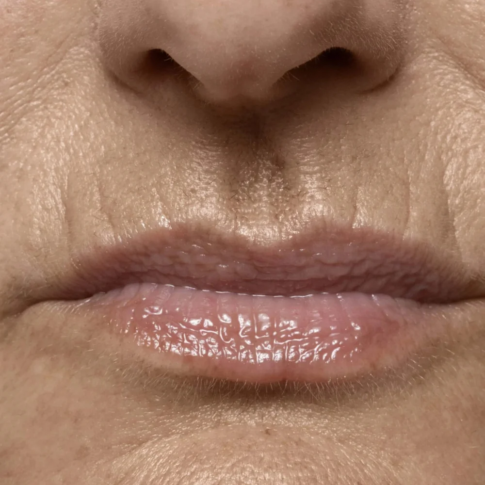 Lip Lines